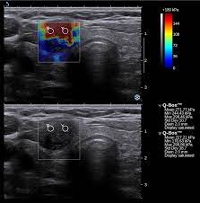 Elastography Imaging